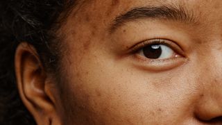 A Black woman with hyperpigmentation on her cheeks